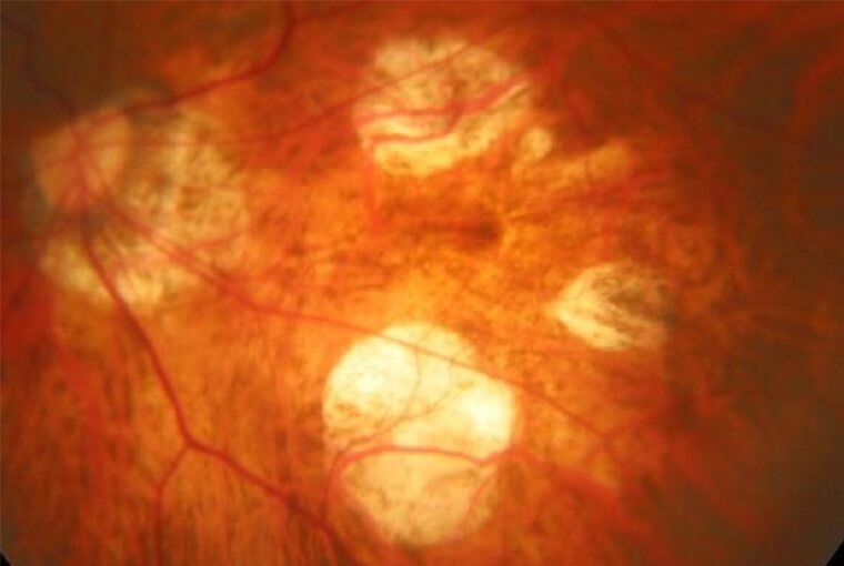 高度近視に伴う網脈絡膜萎縮